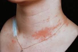 Allergic reaction to jewellery around neck
